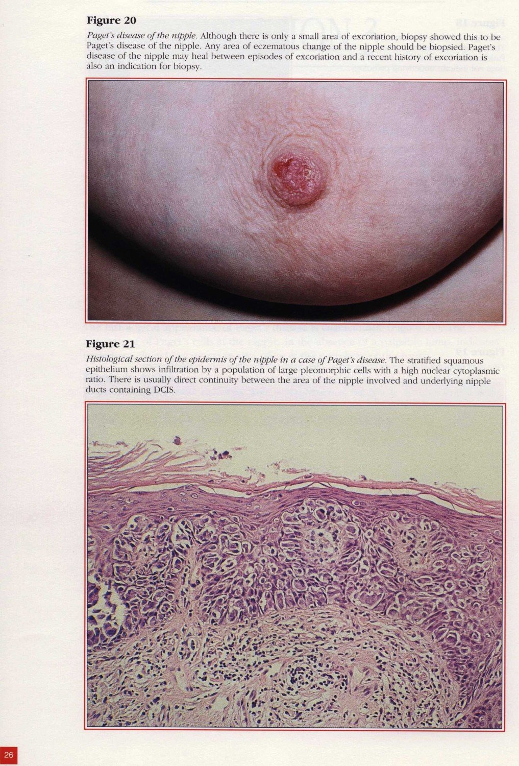breast cancer disease r Co worker ladies naked